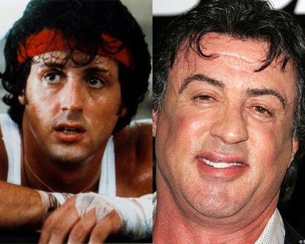Sylvester Stallone after Plastic Surgery