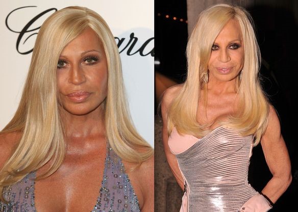 Donatella Versace after cosmetic Surgery