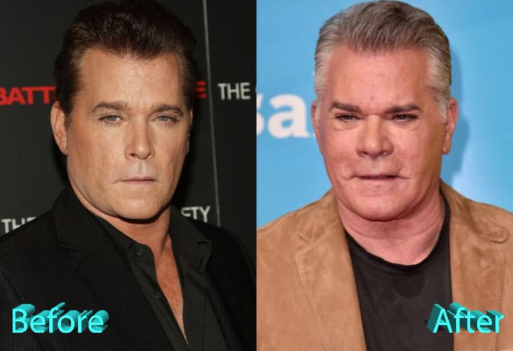 Ray Liotta Before and After Cosmetic Surgery