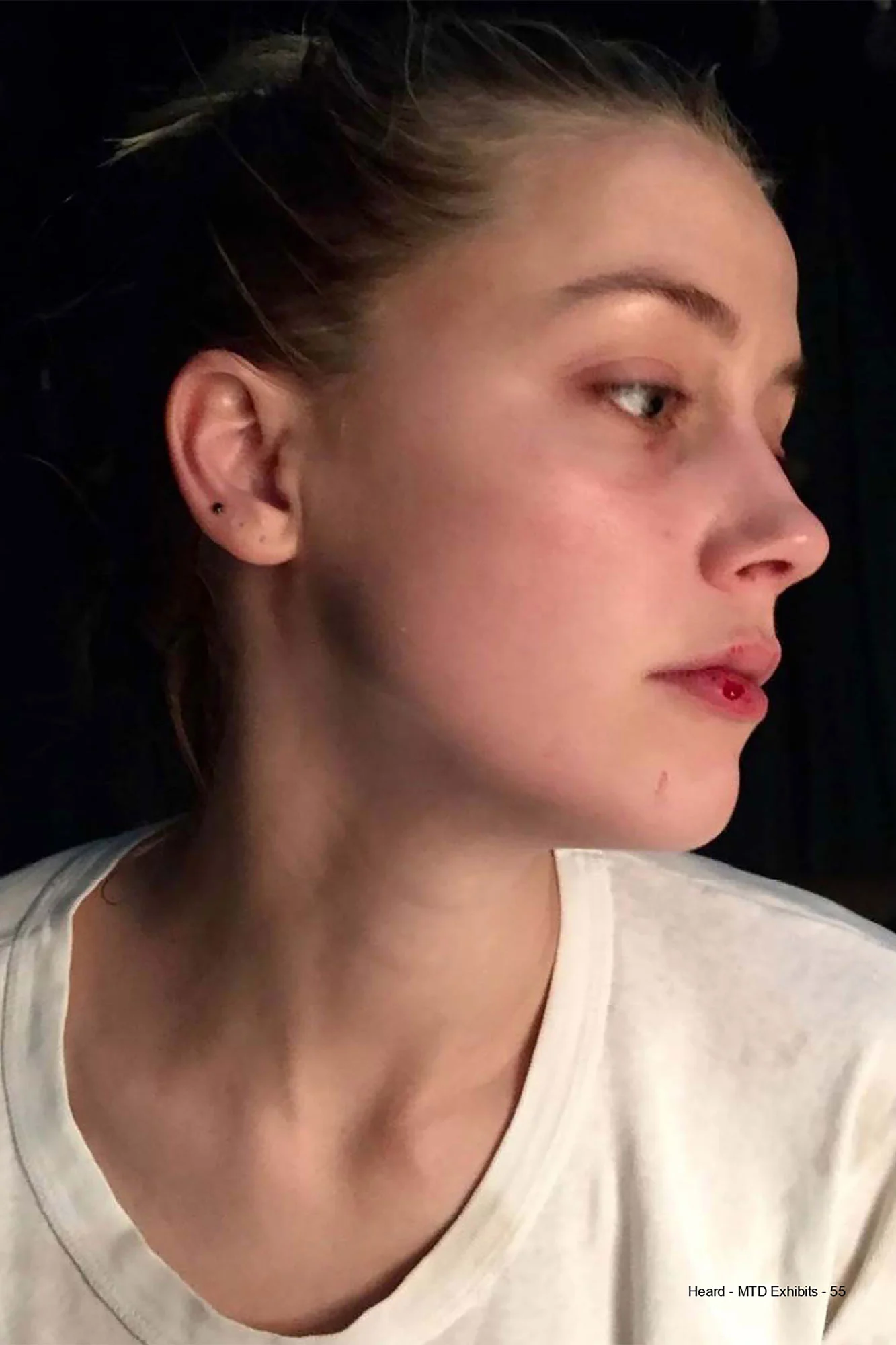 Amber heard's face injuries, photo presented during Amber Heard Johnny Depp trial