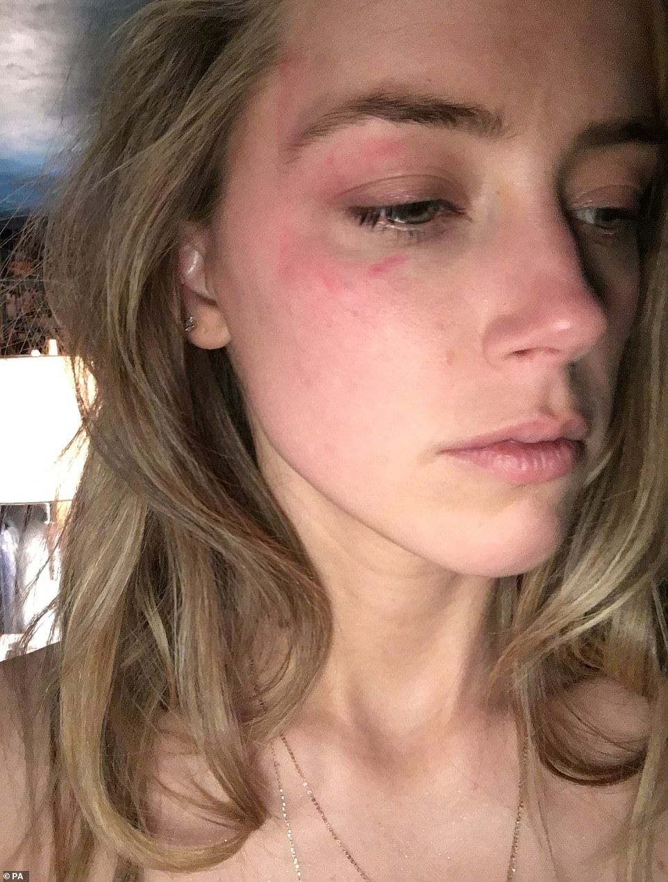 Amber Heard Abuse Picture